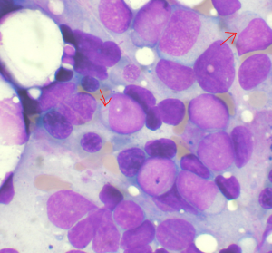 Leukemia markers